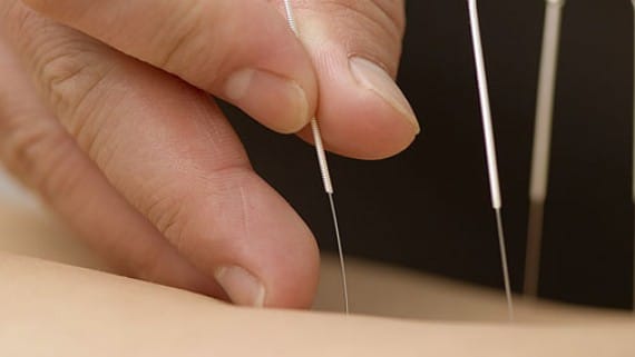 How Acupuncture at Synergy Health Centre can Benefit You