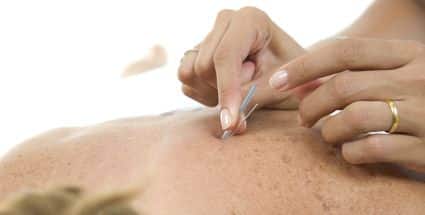 Intramuscular Stimulation / IMS/ Dry Needling/ Acupuncture