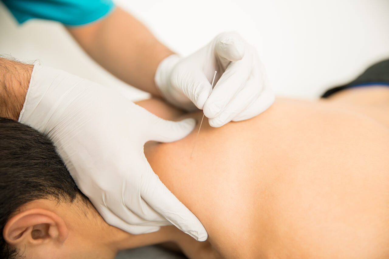 dry needling physiotherapy victoria