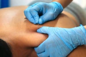 is dry needling the same as acupuncture