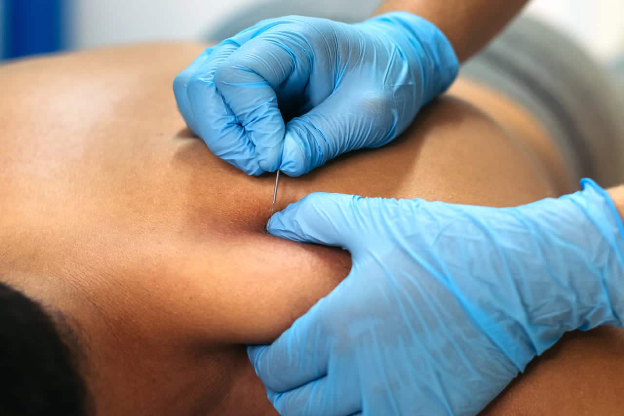is dry needling the same as acupuncture